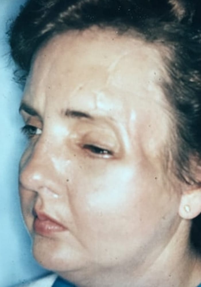 Before Image: Cranio Orbital Facial Fracture - left-front-oblique