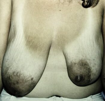 Before Image: Asymmetric Breasts - front