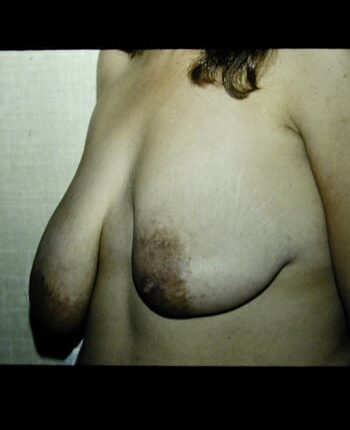 Before Image: Asymmetric Breasts - left-front-oblique