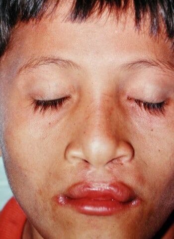 After Image: Bilateral Cleft Lip - front
