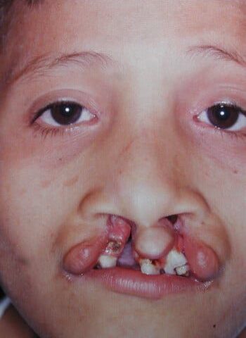 Before Image: Bilateral Cleft Lip - front