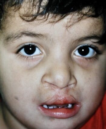 After Image: Bilateral Cleft Lip - front