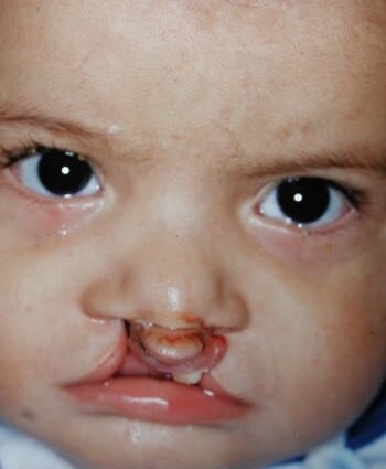 Before Image: Bilateral Cleft Lip - front