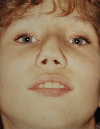 Before Image: Nasal Reconstruction - front