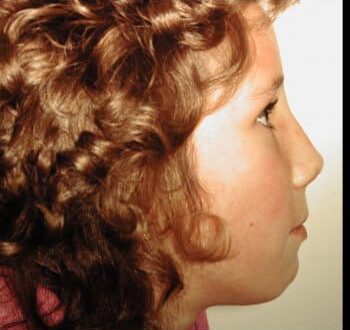 After Image: Nasal Reconstruction - right-side