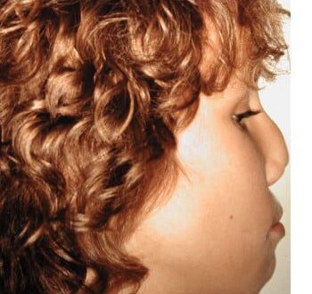 Before Image: Nasal Reconstruction - right-side