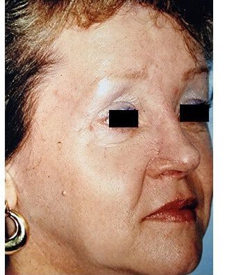 Before Image: Nasal Reconstruction - right-front-oblique