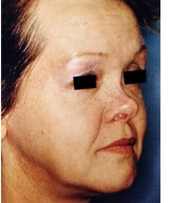 After Image: Nasal Reconstruction - right-front-oblique