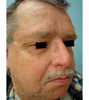 After Image: Nasal Reconstruction - right-front-oblique