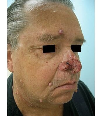 Before Image: Nasal Reconstruction - right-front-oblique