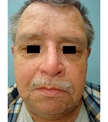 After Image: Nasal Reconstruction - front