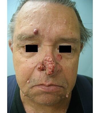 Before Image: Nasal Reconstruction - front