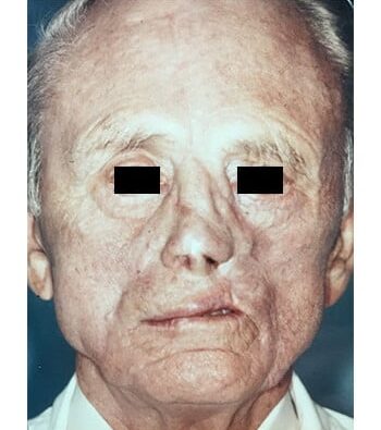 After Image: Nasal Reconstruction - front