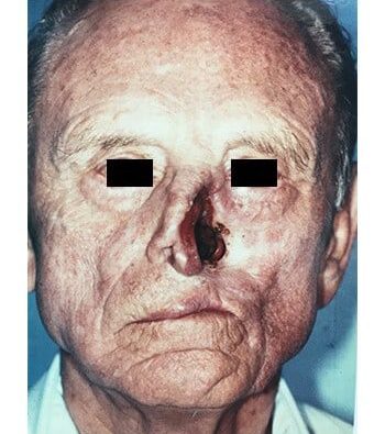 Before Image: Nasal Reconstruction - front