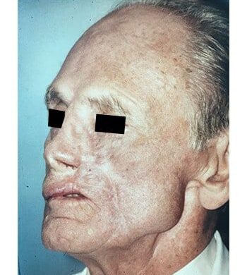 After Image: Nasal Reconstruction - left-front-oblique