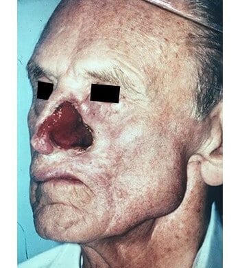 Before Image: Nasal Reconstruction - left-front-oblique