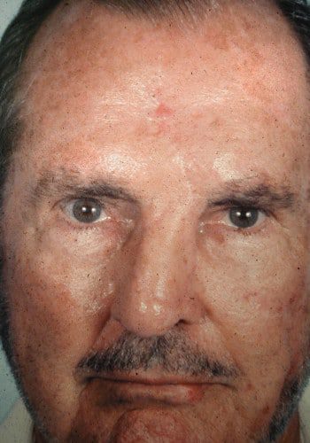 After Image: Nasal Reconstruction - front