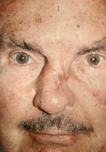 Before Image: Nasal Reconstruction - front