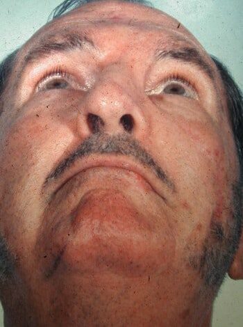 After Image: Nasal Reconstruction - front