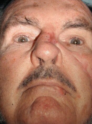 Before Image: Nasal Reconstruction - front