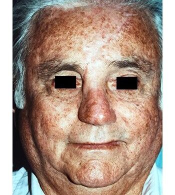 After Image: Nasal Reconstruction - front
