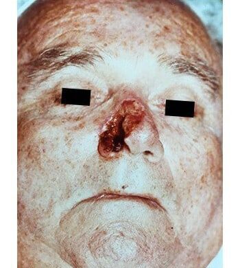 Before Image: Nasal Reconstruction - front