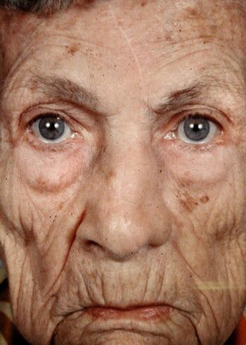 After Image: Nasal Reconstruction - front