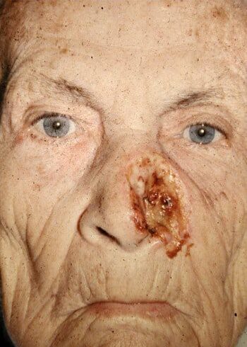 Before Image: Nasal Reconstruction - front