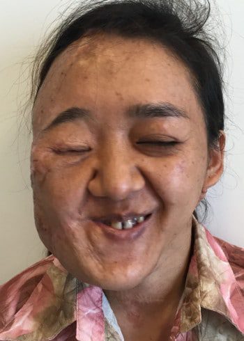 After Image: Neurofibroma - front