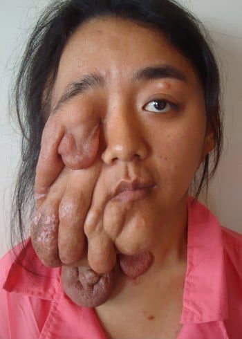 Before Image: Neurofibroma - front