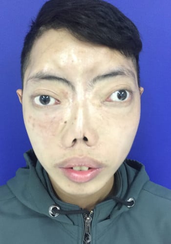 After Image: Craniofacial Tumor - front