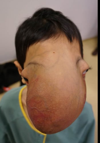 Before Image: Craniofacial Tumor - front