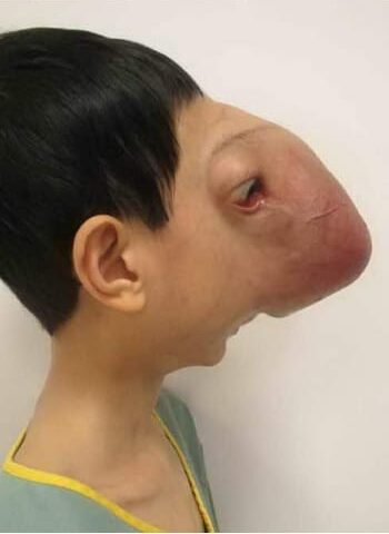 Before Image: Craniofacial Tumor - right-side
