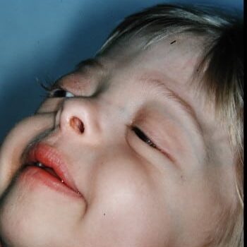 After Image: Craniosynostosis - front