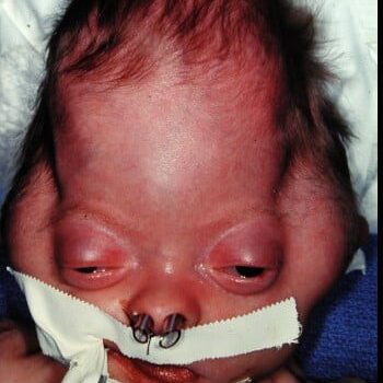 Before Image: Craniosynostosis - front
