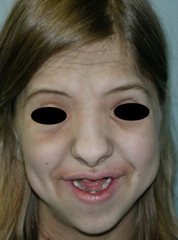 After Image: Craniosynostosis - front