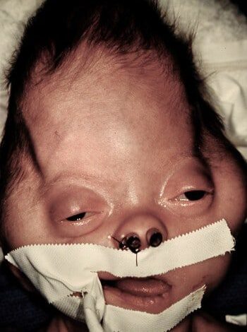 Before Image: Craniosynostosis - front