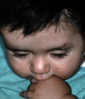After Image: Craniosynostosis - front
