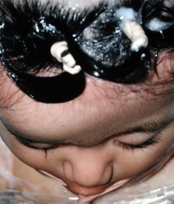 Before Image: Craniosynostosis - front