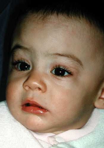 After Image: Craniosynostosis - front