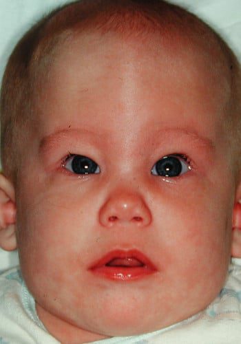 Before Image: Craniosynostosis - front