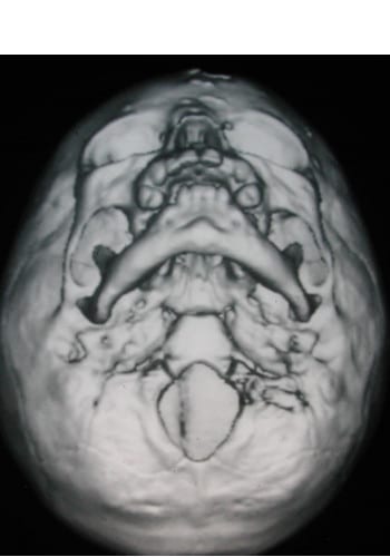 After Image: Craniosynostosis - front