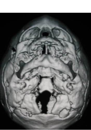 Before Image: Craniosynostosis - front