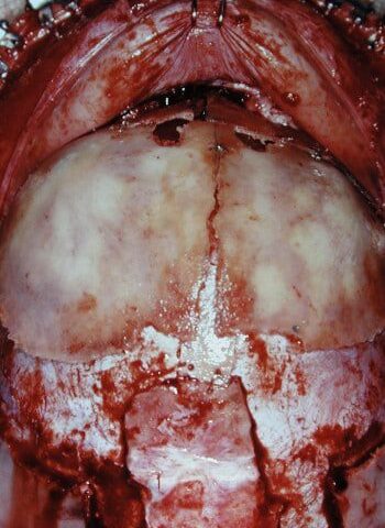 After Image: Craniosynostosis - back