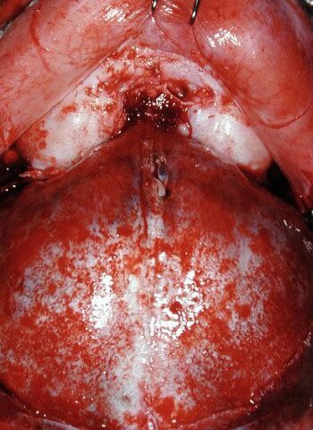 Before Image: Craniosynostosis - back