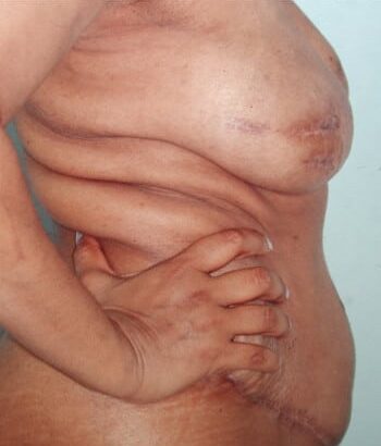 After Image: Breast Reconstruction - right-side