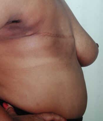 Before Image: Breast Reconstruction - right-side