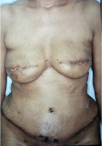 After Image: Breast Reconstruction - front