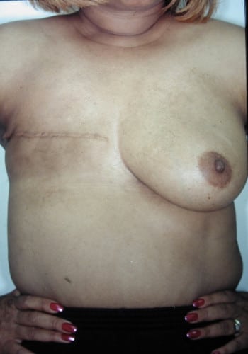 Before Image: Breast Reconstruction - front