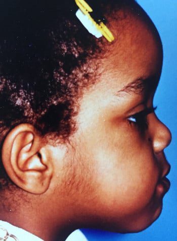 After Image: Venous Malformation - right-side